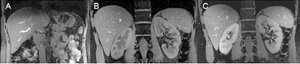 (A) T2-weighted HASTE image in a human volunteer; note the absence of signal dropouts. (B) Gradient echo image with fat saturation and (C) gradient echo image with water saturation; the saturation is effective throughout the entire slice.